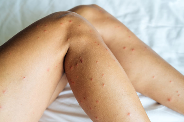 Understanding The Bed Bug Skin Rash - Bed Bug Injuries